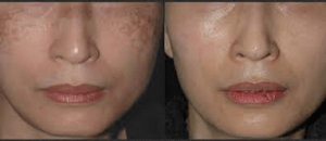 before and after medical beauty treatment in boca raton