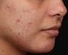 skin treatment procedure in boca raton