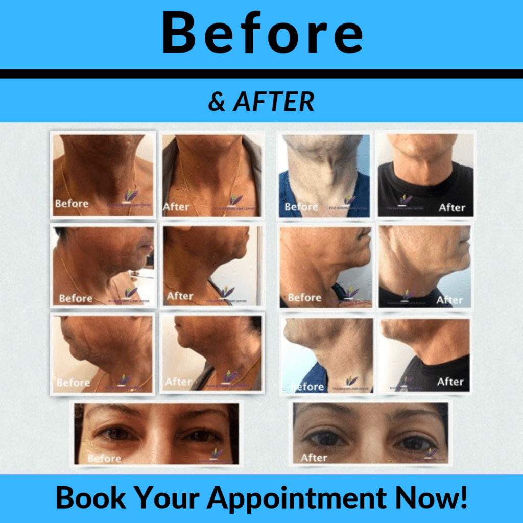 Before and after plasma fibroblast skin tightening procedure.