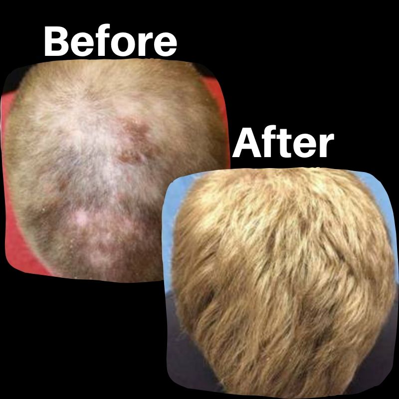Before and after hair regrowth treatments.