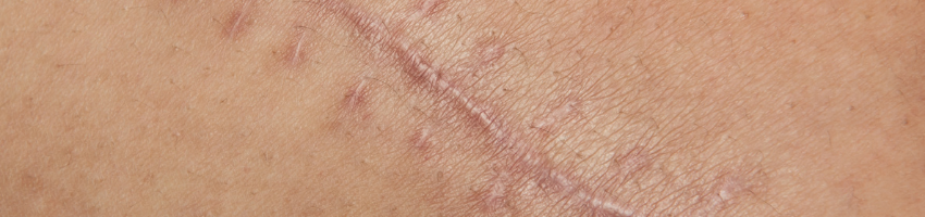 scar