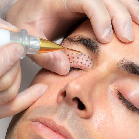 Plasma Fibroblast in Boca Raton