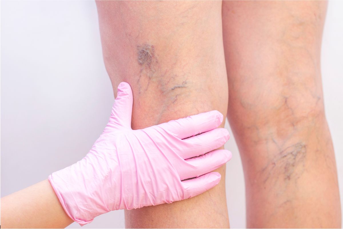 The doctor examines the spider veins on the patient's legs.