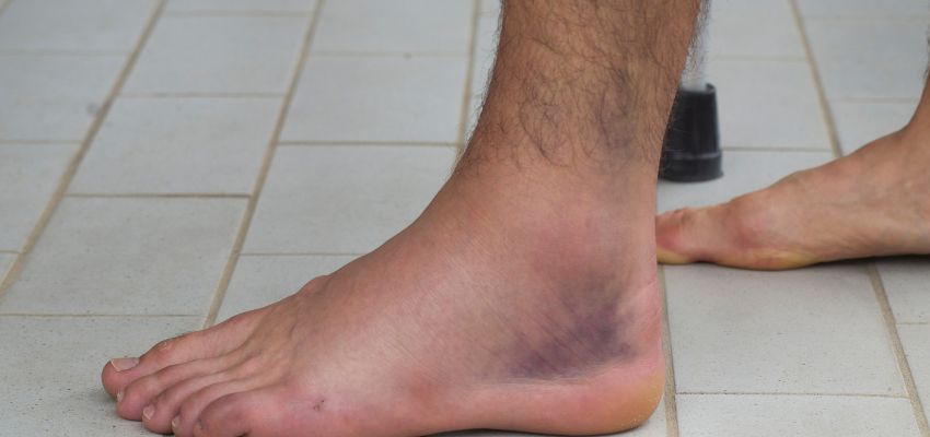 The woman has dark ankles due to poor blood circulation in her veins.